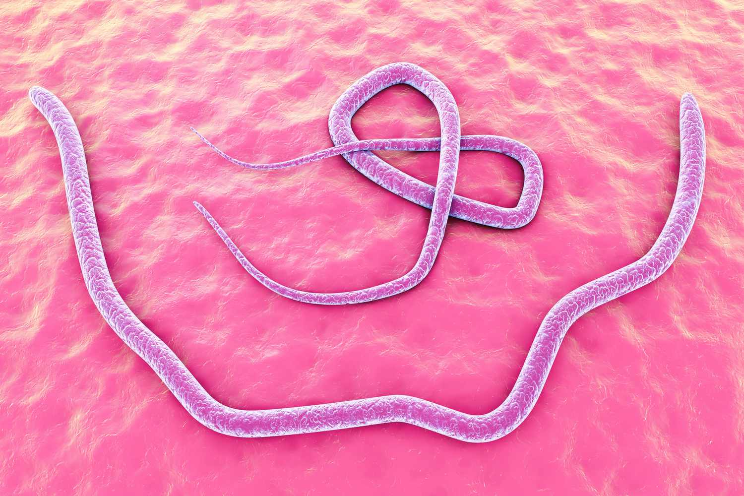 Ascariasis