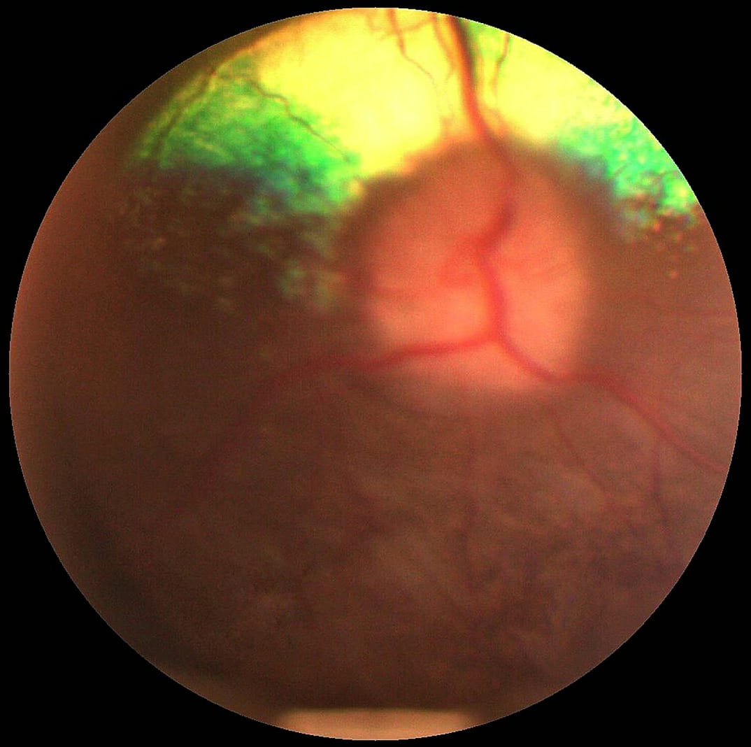 Retina Kanaması